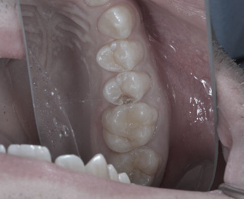 Une dentition réparée grâce à la technique Inlay / Onlay
