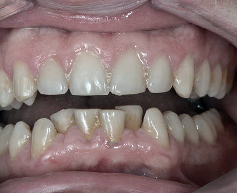La gingivite est une maladie parodontale