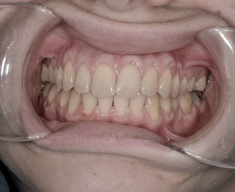 Une exemple de récéssion parodontale chez ce patient du docteur Mimoune