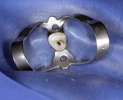 Comment traiter l'endodontie dentaire ?