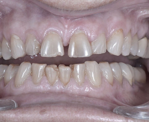 Vue d'une dentition avant la pose de facette dentaire