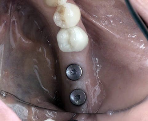 L'implant dentaire permet de poser une prothèse dentaire